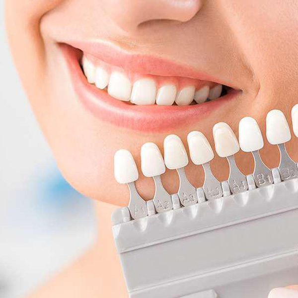 سفید کردن دندان ها با روکش دندان